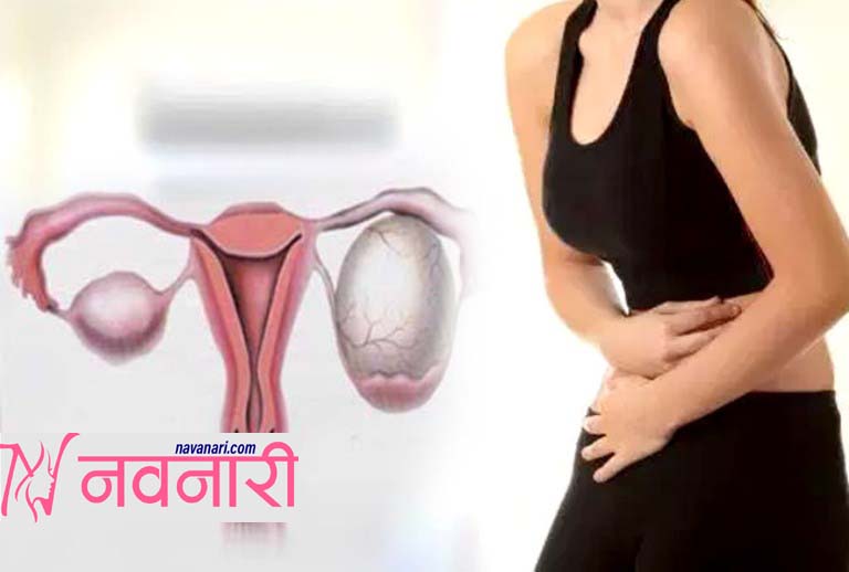 पाठेघर खस्ने कारण, लक्षण र रोकथामका विधि