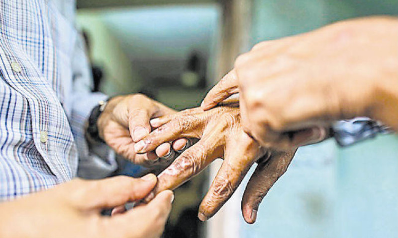 मधेश प्रदेशका जिल्लाहरुमा कुष्ठरोगको जोखिम